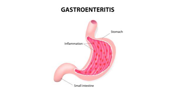 Gastroenteritis