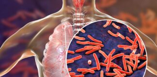 Tuberculosis, Kaduna