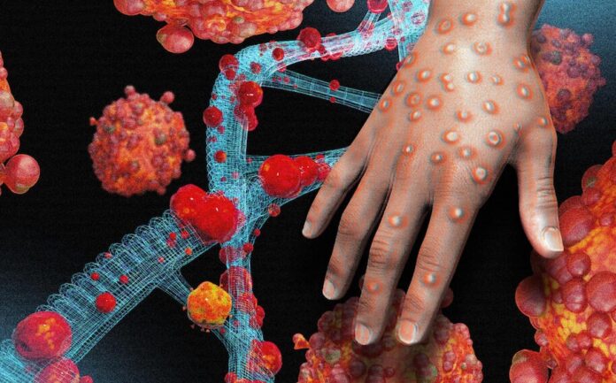 monkeypox-1 NCDC, monkeypox